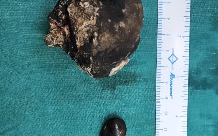 एसएन के डाक्टरों ने जटिल सर्जरी कर गुर्दे से निकाली चार सौ ग्राम की पथरी