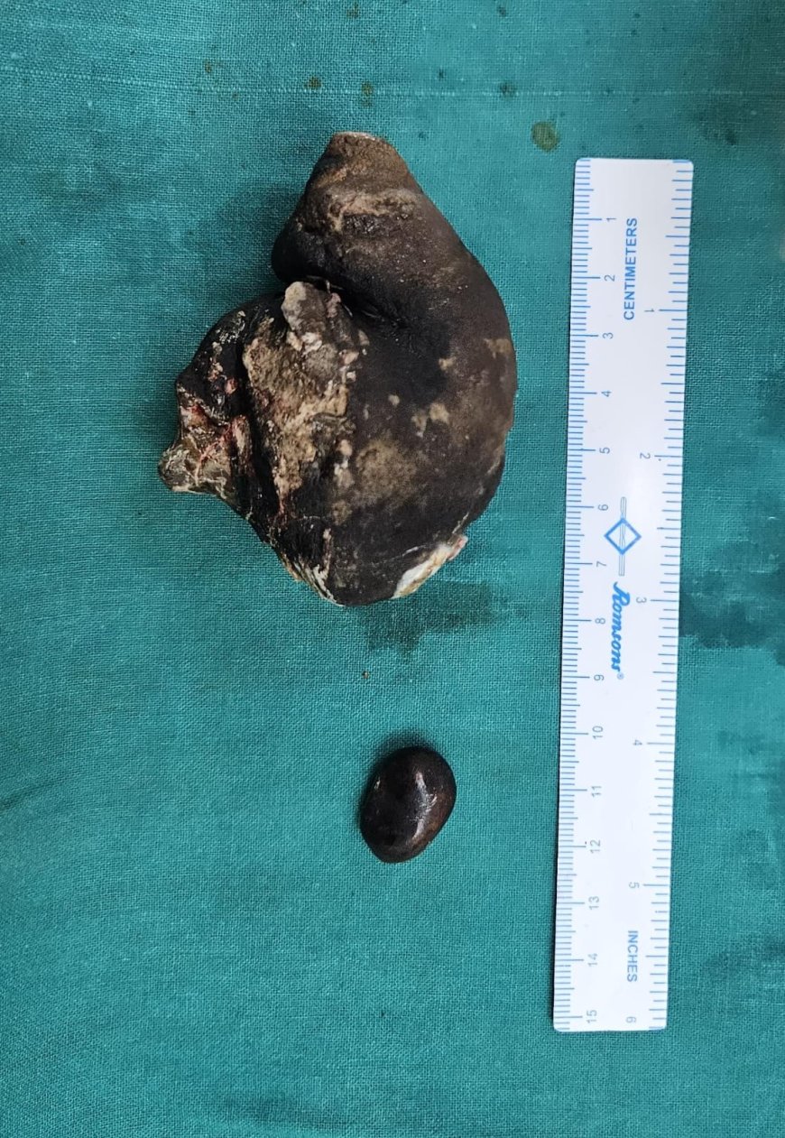 एसएन के डाक्टरों ने जटिल सर्जरी कर गुर्दे से निकाली चार सौ ग्राम की पथरी