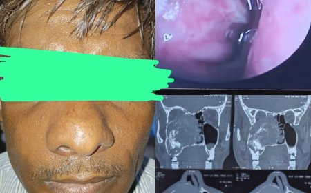 एसएन मेडिकल कॉलेज में जटिल ऑपरेशन से जबड़े का विशाल ट्यूमर सफलतापूर्वक निकाला गया