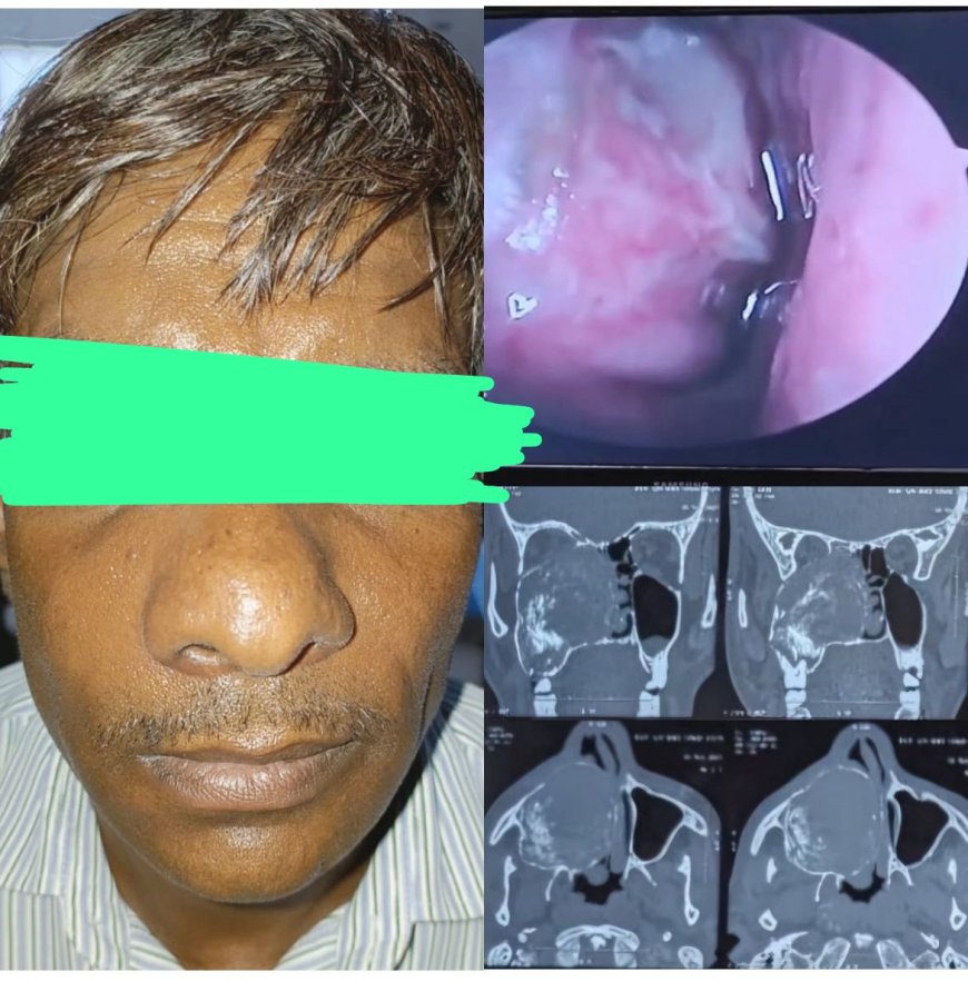 एसएन मेडिकल कॉलेज में जटिल ऑपरेशन से जबड़े का विशाल ट्यूमर सफलतापूर्वक निकाला गया