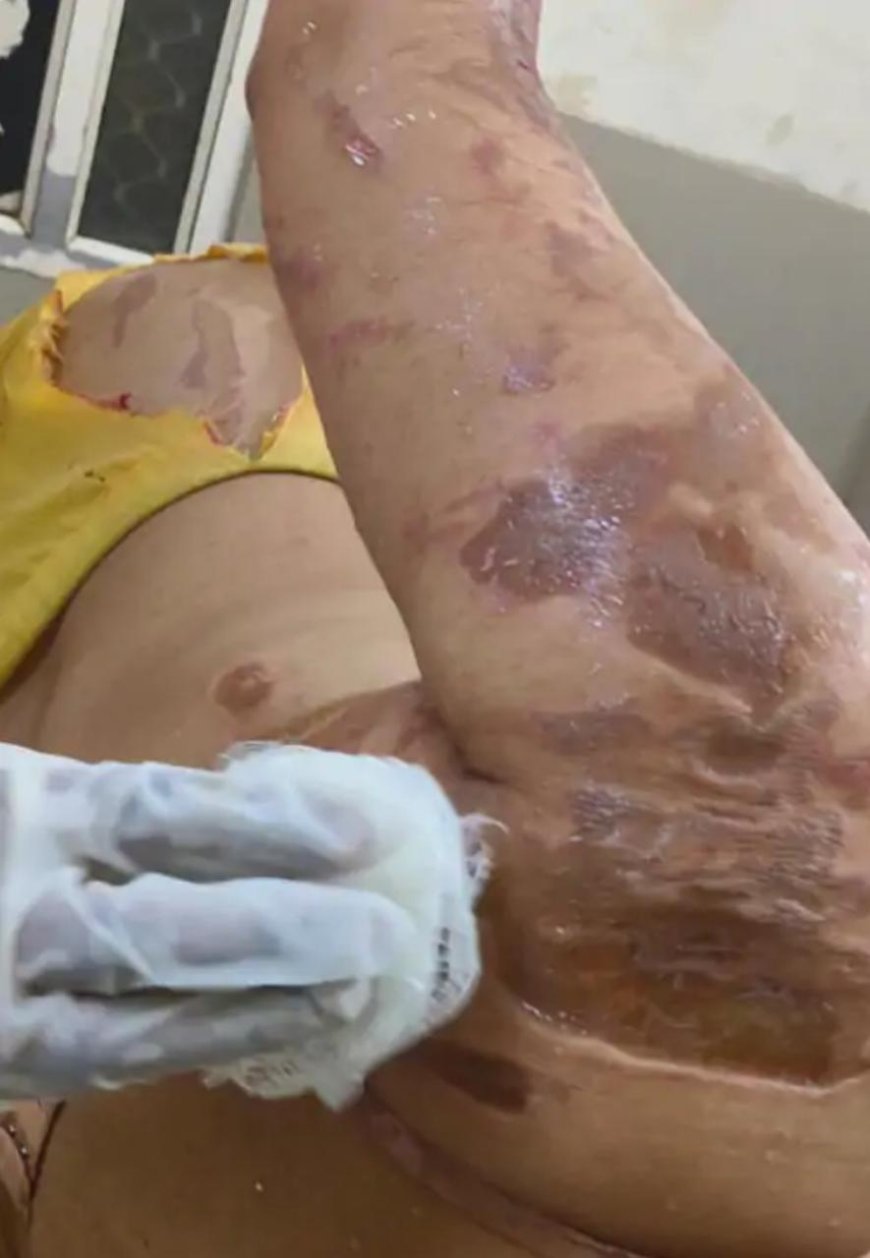 आगरा में दहेज की मांग पर बर्बरता: मायके से पैसे न लाने पर पति ने पत्नी पर फेंका तेजाब, पीठ और छाती तक जली