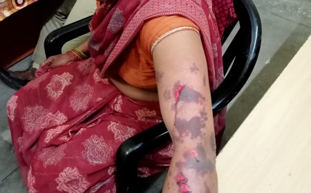 फतेहपुर सीकरी क्षेत्र में दो घटनाएं: मामूली विवाद में दो पक्ष भिड़े, हाईवे हादसे में युवक घायल