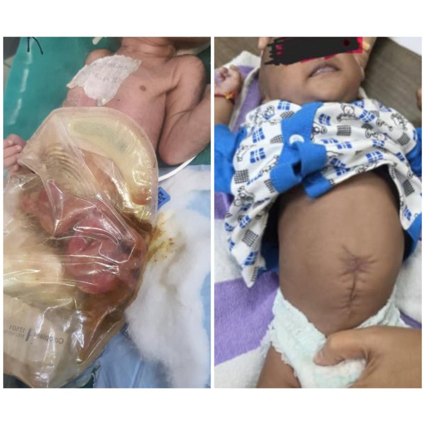 आगरा के एसएन ने किया मेडिकल चमत्कार, पेट से बाहर निकली आंतों वाले 1.4 किलो के नवजात को दी नई जिंदगी