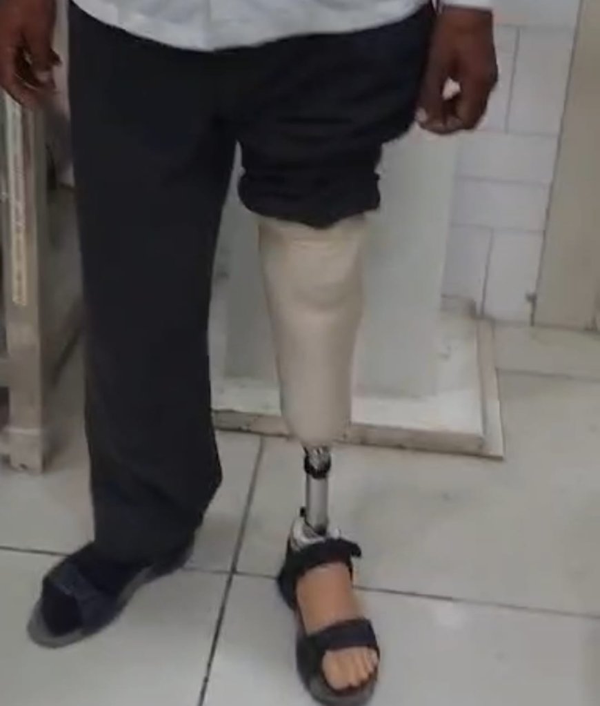 आगरा के श्री राम शशि लिम्ब सेंटर में मात्र 35 हजार में हाई-टेक कृत्रिम पैर से 72 वर्षीय राजवीर सिंह को मिली राहत, पहले ही दिन चलने लगे